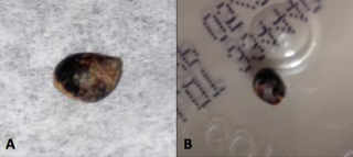 El caracol encontrado. BMJ Case Reports